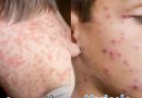 GOBIERNO DEL ESTADO REFUERZA CAMPAÑA INFORMATIVA SOBRE SARAMPIÓN Y VIRUELA