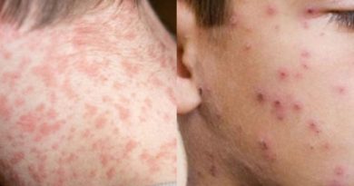 GOBIERNO DEL ESTADO REFUERZA CAMPAÑA INFORMATIVA SOBRE SARAMPIÓN Y VIRUELA